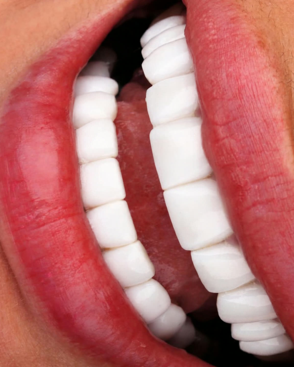 Close-up of opaque, artificial-looking veneers