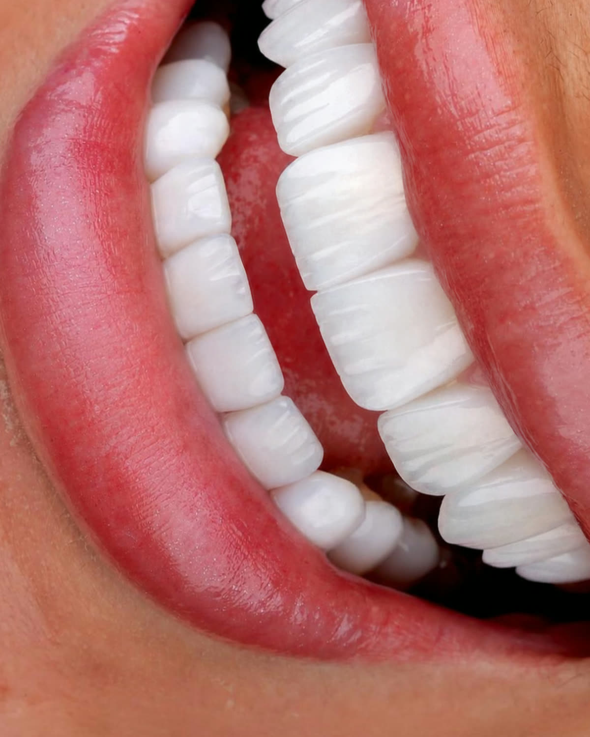 Close-up of refined, natural-looking veneers